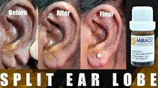 How To Repair Split Ear Lobe Without Surgery Split Ear Lobe Repair Procedure With Ear Pasting lotion
