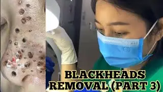 Heavy Blackhead  Removal Video (PART 3)