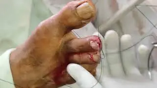 Figure of 8 Suture technique. Over nail injury. #sutures #ayurveda #surgeon_of_life #surgery