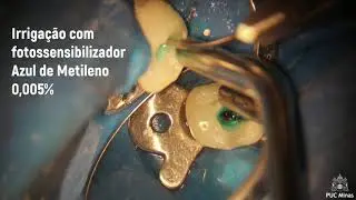Gota #35 - PHOTODYNAMIC THERAPY - PDT (TERAPIA FOTODINÂMICA)