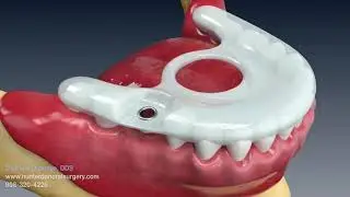 Dr. Olawoye talks dental implants on #CBS news show with patient testimonial