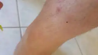 Tick removal