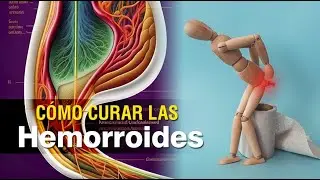 👨🏻‍⚕️ Cómo curar las hemorroides de forma rápida, eficaz y naturalmente 🍏🩺
