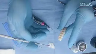 Rehabilitación de arcada completa con caracterización de sobre dentadura