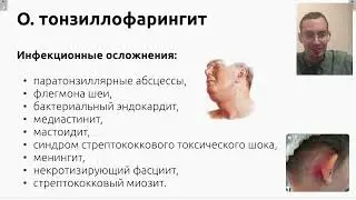 Острый тонзиллофарингит