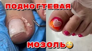 Как убрать подногтевую мозоль 🦶Педикюр 🦶дизайн ногтей на ногах