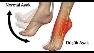 DÜŞÜK AYAK