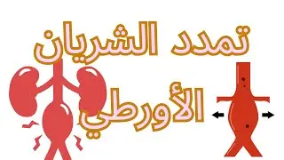 تمدد الشريان الأورطي، انت مش لوحدك!