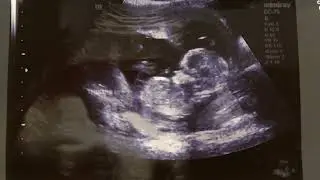 Unborn baby gives us a thumbs up!