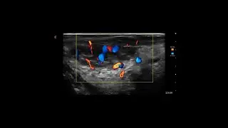 Hemangioma of the Tongue Ultrasound