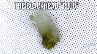 Blackheads & Pimple Popping!  PimplePopper.org