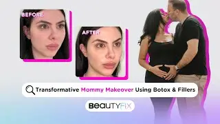 Mommy Makeover Transformation with Botox & Fillers | BeautyFix