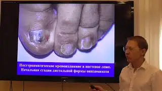 Лечение подногтевого грибка Ламиконом. Ерошкин Е.Ю.
