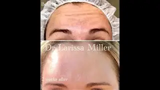 Instructions how to use Vista Clinic Home peel (Mandelic Acid) on a weekly basis to enhance results