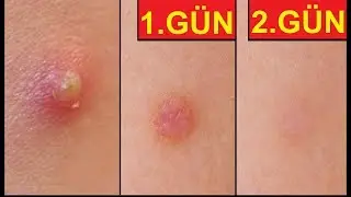 2 GÜNDE SİVİLCE YOK ETME TAKTİĞİ