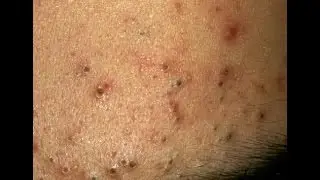 Таблетки от черных точек