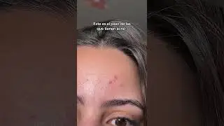 Este es el paso de las que tienen acné: