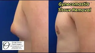 Tissue Removed from Gynecomastia | Orange County Plastic Surgery #gynecomastiaresult