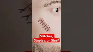 STITCHES, STAPLES, OR GLUE?    #medical #medicalstudent #science #sciencefacts #viralshorts