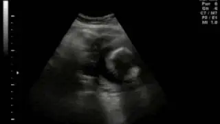 Our 3rd Baby's 20-Weeks 3D/4D Ultra Sound