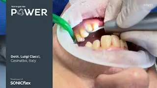 KaVo SONICflex restorative application