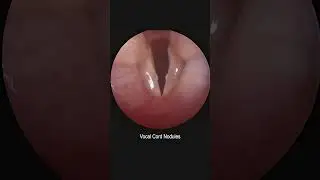 Pediatric Vocal Cord Nodules Development and Resolution Time Lapse