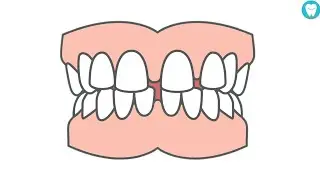 How To Close Gaps Between Teeth (Without Braces)