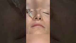 Use this simple needle trick for smoother vertical lip injections
