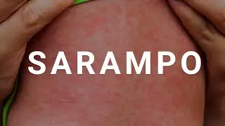 SARAMPO