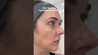 MelanoPro results- a hyperpigmentation treatment for all skin types #pigmentation #darkspots