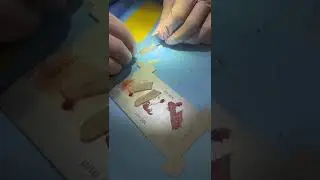 Autologous costal cartilage is excellent source of grafting material in nose.#rhinoplasty#rinoplasti