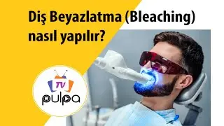 Diş Beyazlatma (Bleaching) nasıl yapılır? Aşama aşama uygulama videosu