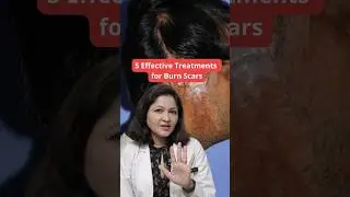 Best Treatment for Burn Scar | Microneedling for Burn Scars | co2 Laser Burn Scars | SB Aesthetics