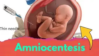 Amniocentesis class 12 biology | Amniocentesis test