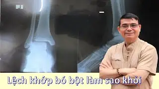 CỔ CHÂN LỆCH XƯƠNG SÊN CHỈ ĐỊNH BÓ BỘT SAO KHỎI ĐƯỢC - anklets