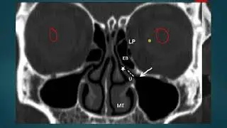 OSTEOMEATAL COMPLEX UNIT (OMC) ON CT ANATOMY SIMPLIFIED