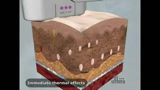 Ulthera Animation