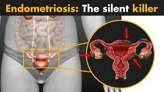 Endometriosis | What you need to know?