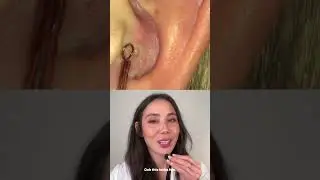 Cyst in Ear