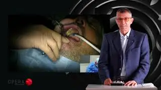 ULTRA - Dr Olivo commenta chirurgia