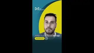 James’ experience with DrT Hair #hairtransplant