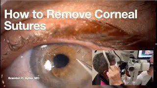 Resident/Fellow Series-How to remove corneal sutures