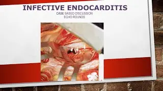 Echocardiography in infective endocarditis: Case-based discussions
