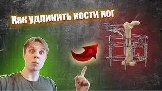 Как УДЛИНИТЬ Ноги | Аппарат Иллизарова