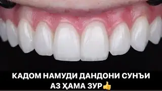 Намуди дандонҳои сафед