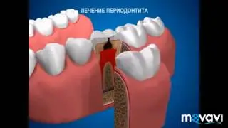 Эндодонтическое лечение зуба