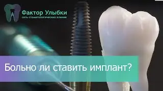 Больно ли ставить имплант? - рассказывает врач-стоматолог