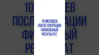 Классный результат после липосакции и удаления диастаза в Южной Корее