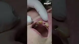 Prosthetics on an implant 