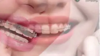 Aparelho OdontoCompany